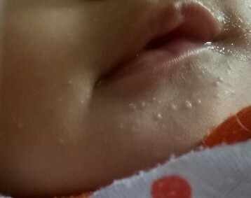 อันนี้เรียกผื่นอะไรค่ะ