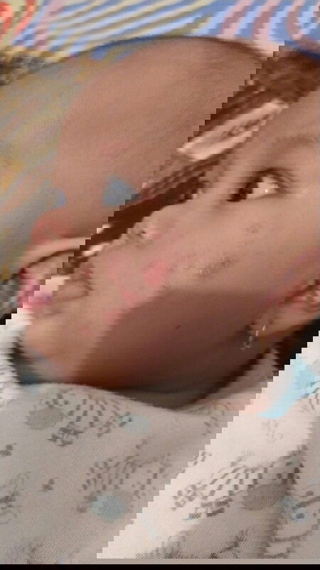 Bund mau tanya kira2 ruam di pipi anak sy bisa membaik dikasih cream apa ya?