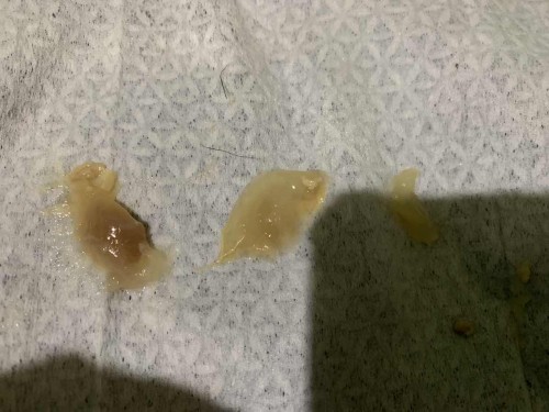 Discharge after cs