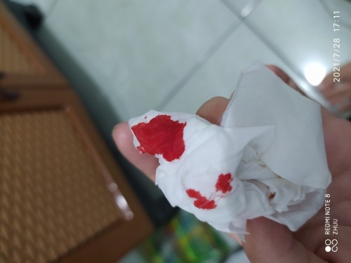 Saya kok mimisan saat hamil