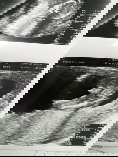 แบบนี้ ผช ชัวไหมค่ะแม่ๆ คุณหมอบอก ผช แม่ดูไม่ค่อยเป็นค่ะ 17วีค4วันค่