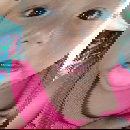 กลากน้ำนมหรือโรคด่างขาว