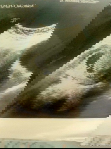 10+5w หมอบอกว่าเด็กตัวเล็กเกินกว่าอายุครรภ์ วันนี้นัดตรวจอีกครั้ง ว่าน้องจะไปต่อกับแม่หรือไม่