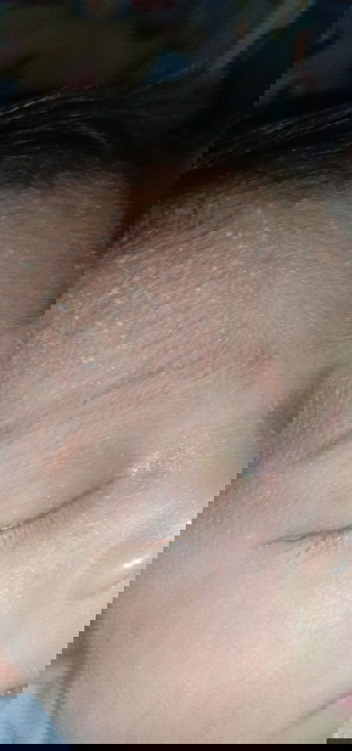 น้องเป็นตุ่มแบบนี่ คือตุ่มอะไรคะ
น้องอายุ10วัน ทาอะไรถึงจะหายคะ