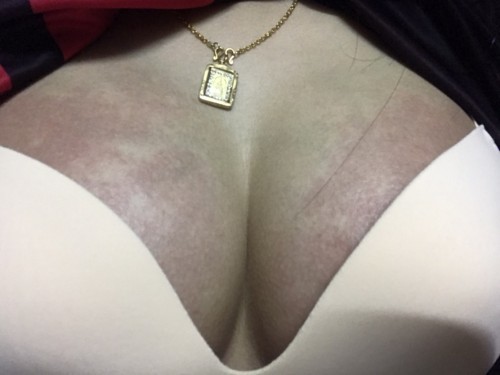 เป็นผื่นน แดงงงงงงงง