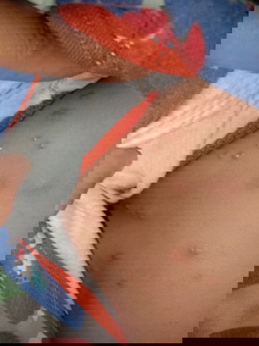 Bintik merah di babyi usia 9 bulan