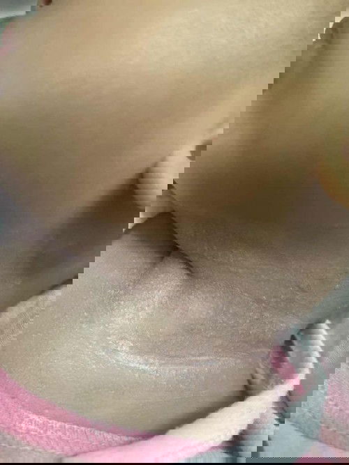 Butlig ni baby sa katawan