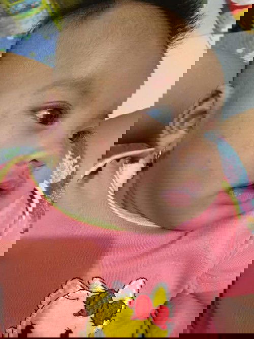 Bintik merah pada bayi 2 bulan