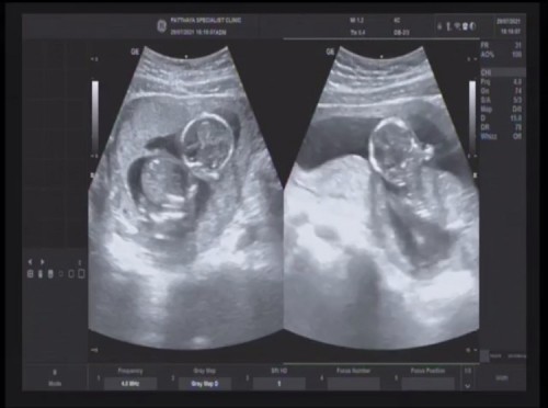 เรื่องราววันที่29/07/64ท้องแรกยินดรต้อนรับสองพี่น้อง