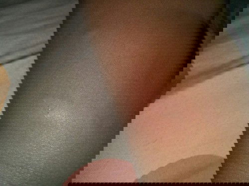 bintik bintik gatal pada kulit anak