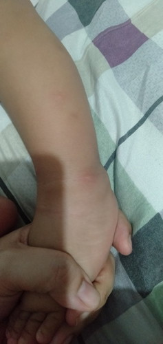 ano kaya itong naglalabasan sa skin ng baby ko.9months na sya.kpag pawala na mangingitim nman po sya
