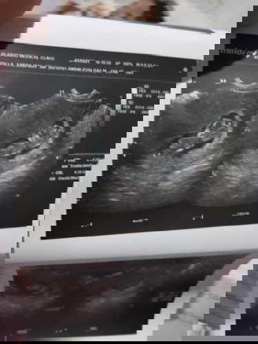 Tanong ko po Ilan months po gagalaw c baby natatakot kasi ako bakit di PA sya nagalaw 3months preggy