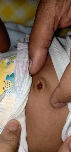 normal ba sa pusod ni baby