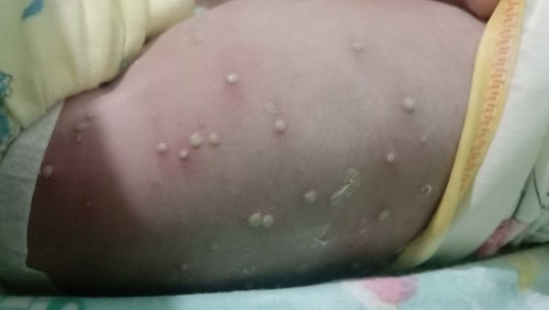 Badan bayi bintik bernanah