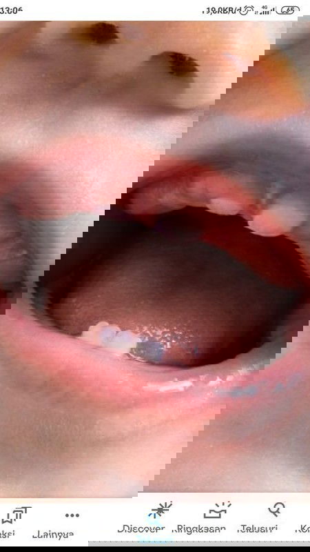 Lip Tie & Tongue Tie