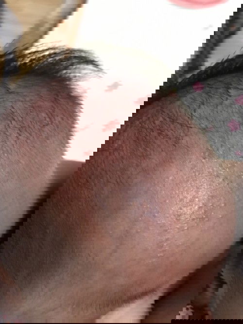 ผดผื่นลูกน้อย...