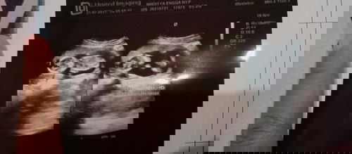 Apakah bayi berkembang sempurna ?