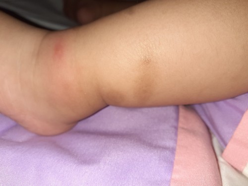 Hi mommies! Meron po ba same case dito sa baby ko na kapag nakagat ng lamok or insect nagbubutlig?