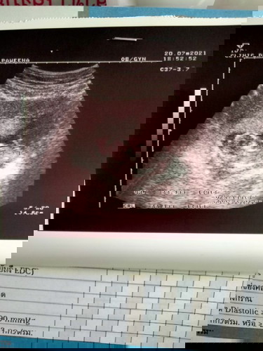 หนูน้อย14+5ท้องสองค่ะ