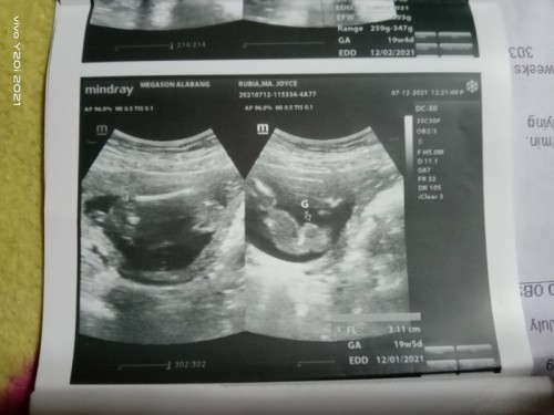 PAG GANYAN PO BA LUMABAS SA ULTRASOUND GIRL NA PO BA TALAGA?
