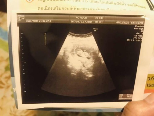 อัลตร้าซาวด์รอบ2ตอน10w