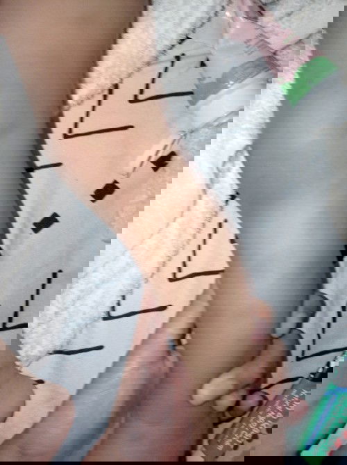 Paano po mawala ang peklat ni baby dahil sa kagat nang lamok.