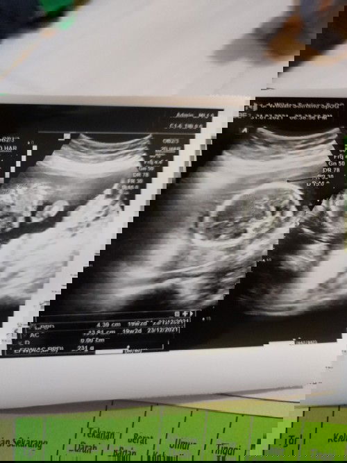 Plasenta ada di bawah