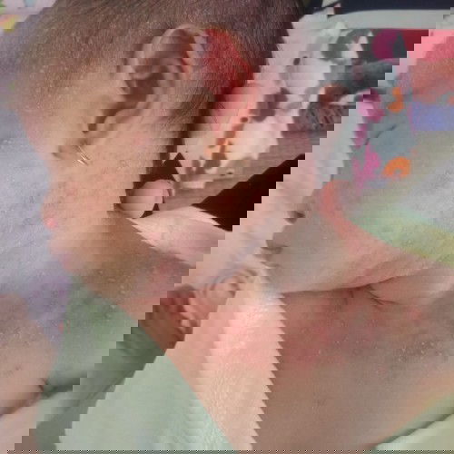 Bé bị nổi mẫn đỏ kèm mụn