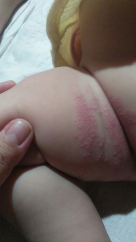ลูก แพ้ผ้าอ้อม