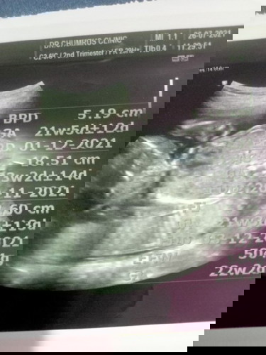 คุณหมอไม่เห็นบอกอะไรเลยบอกแค่ว่าลูกหนัก5ขีดท้อง22w