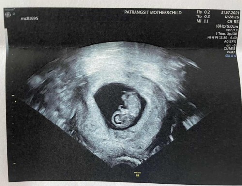 แม่ๆตรวจ NIPT ที่ไหนกันบ้างคะ