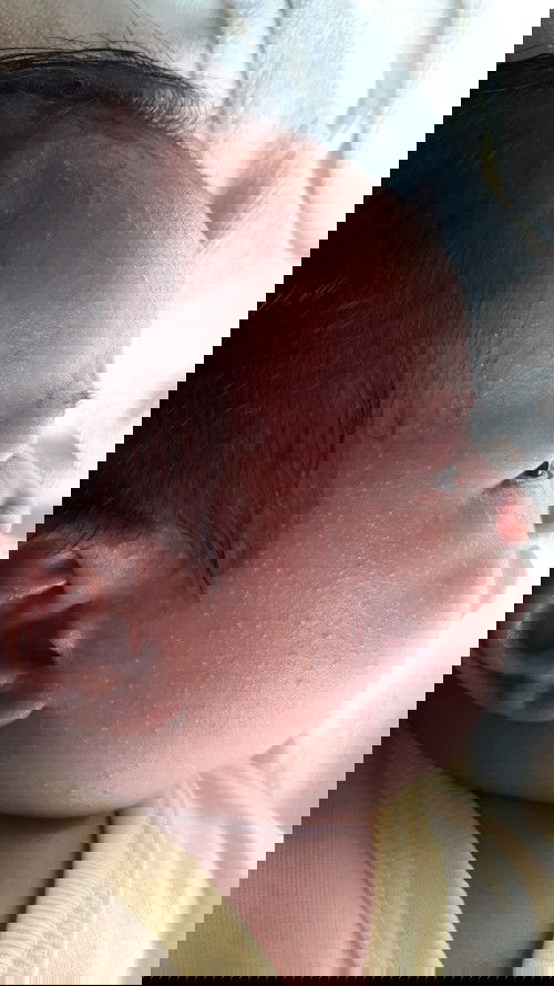 bintik bintik di wajah bayi