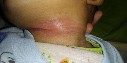Merah dan bintik dileher bayi