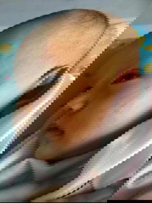 ผื่นที่ขึ้นที่หน้าคือผื่นอะไรหรอคะ