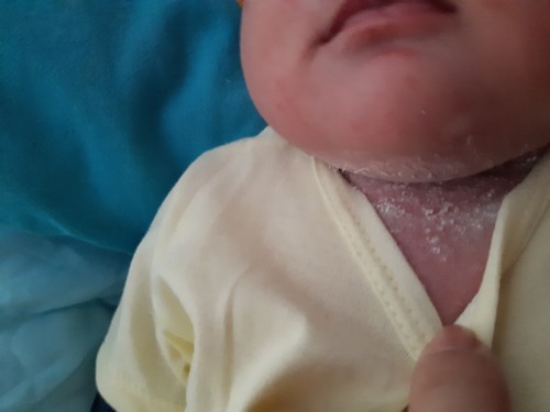 Các mom cho mẹ hỏi. Con minh đc 15 ngay tuổi da của bé phần cổ qua đến phia sau cũng bi giống vậy. C