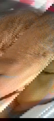 Butlig sa ulo ni baby at nagmumutang mata