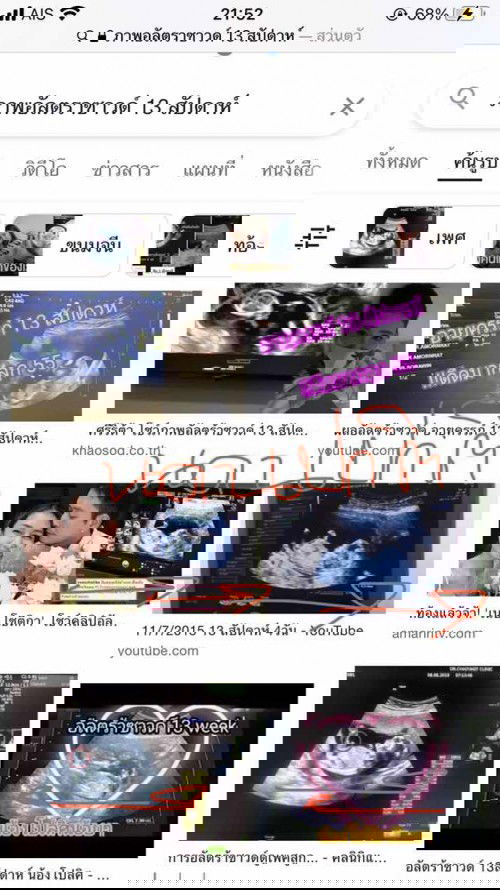 ท้อง 13 วีค แต่ทารกตีลังกา หัวทิ่มลง ปกติไหมค่ะ