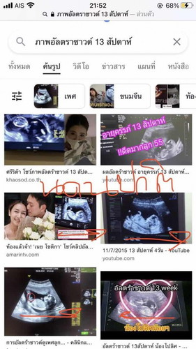 ท้อง 13 วีค แต่ทารกตีลังกา หัวทิ่มลง ปกติไหมค่ะ