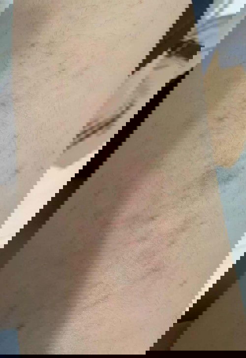 Gatal dipaha (PUPPP)