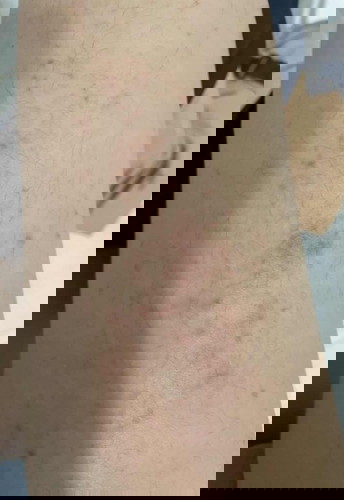 Gatal dipaha (PUPPP)