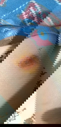 Sugat dahil sa kagat ng lamok