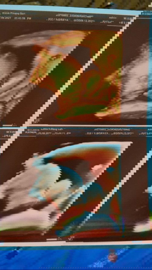 Baby dalam perut ada ginjal polikistik.. ada yang pernah mengalaminya?