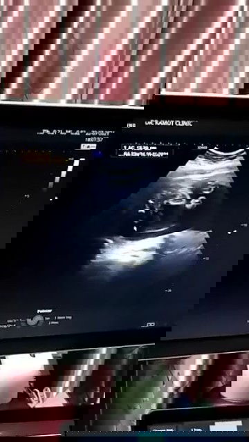 23w ลูกชายอยู่ท่าก้น ยังไม่กลับหัว แม่ๆท่านอื่นอยู่ท่าไหนกันบ้างคะ?