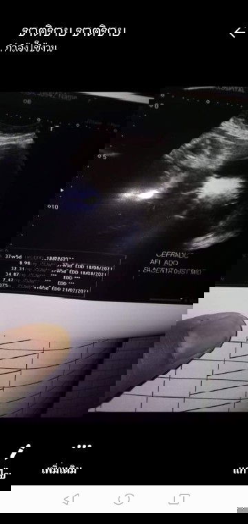 น้ำหนักลูกเขาดูตรงไหนค่ะแม่ๆๆช่วยบอกทึ่​  หมอบอกไม่น่าเกินอาทิตย์​หน้าน้องจะคลอด​   ลูกแข้งแรงดีๆๆๆๆ