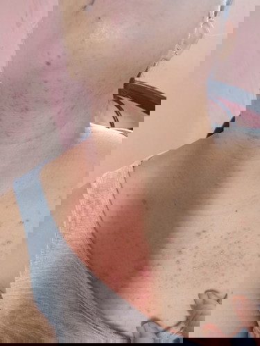 Mga moms ano po kaya pweding igamot dini sa dibdib ko padami na sila ng padami at yun iba makati na.