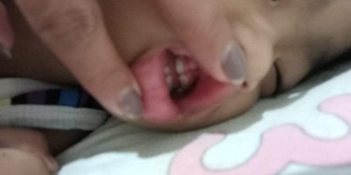 ano po kaya yung puti na nasa itaas ng ngipin ng baby ko?.. ๐