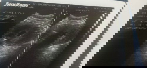 Hasil USG UK 7 minggu