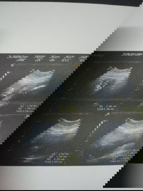 29w6dน้ำหนัก1325ถืกว่าปกติมั้ยคะ
น้องตัวเล็กไปมั้ย น้ำหนักแม่ไม่ขึ้นเลย