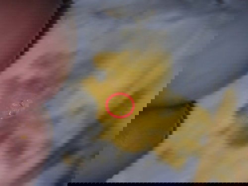 ถ่ายเป็นเลือดฝอย เล็ก ๆ ปน ถ้าแค่นี้ไม่เป็นไรใช่ไหมคะ อาจเพราะเบ่งแรง เลยทำให้เส้นเลือดฝอยแตกไหมคะ