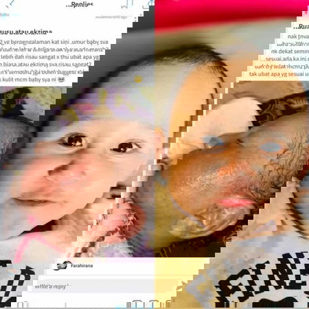 Baby Ruam Eczema ( atopic dermatitis )